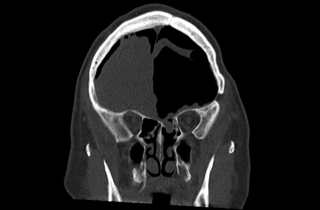 Coronal CT scan demonstrating pneumocephalus with left ethmoid skull base defect with meningoencephalocele and small air bubbles in the area suggesting this was the etiology of the intracranial air.